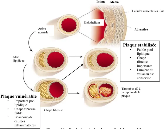 Figure 10 : Evolution de la plaque d’athérome (25) 