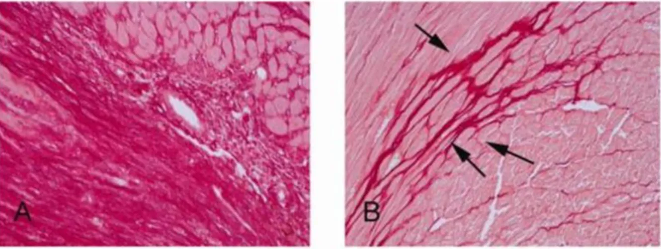 Figure 6. Fibrose cardiaque, histologie. 