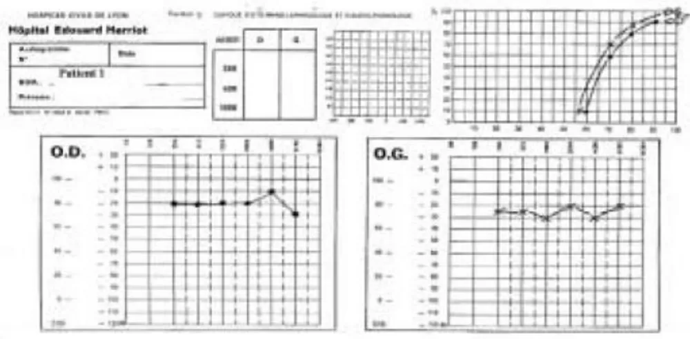 Figure 4 : Audiométrie tonale et vocale d’un patient atteint de NA/DA. Perte auditive moyenne à droite et à  gauche