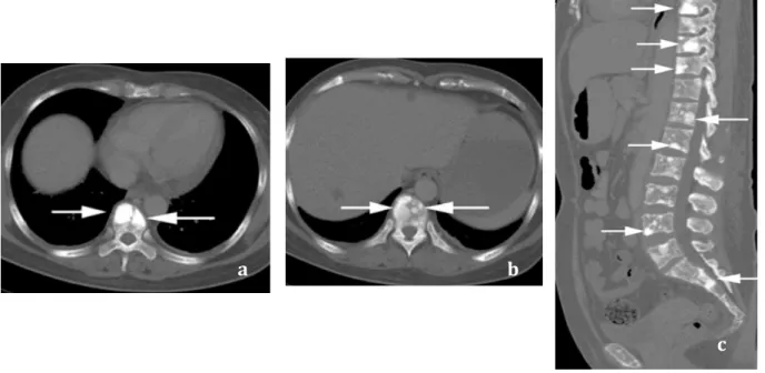 Figure 2 : Scanner d’une femme de 47 ans avec de multiples lésions ostéosclérotiques. a) et b) Coupes axiales c)  Reconstruction d’une coupe sagittale à partie des données de la coupe axiale