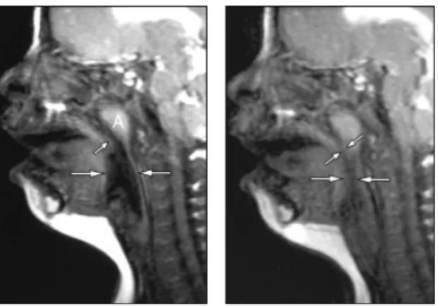 Figure 5 : repousse des adénoïdes chez une jeune fille de 7 ans née avec une T21 souffrant d’un SAOS  persistant après une adéno-amygdalectomie (Donnelly et coll., 2004)