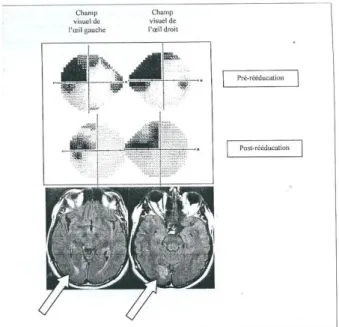 Fig. 5 Rééducation neuropsychologique des troubles neurovisuels d’origine centrale  