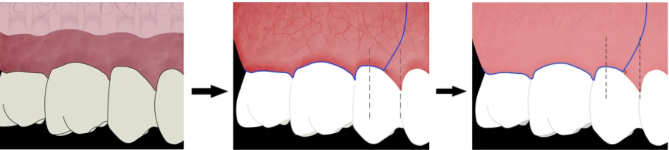 Figure 3 : de gauche à droite, schéma de l’incision de décharge par le SUPTICE :   version n°1, n°2 et finale