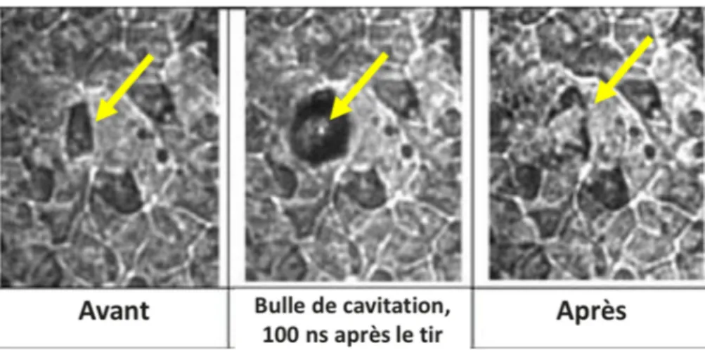 Figure 14. Microcavitation intracellulaire induite par laser, menant à la désintégration d’une cellule d’EPR 99 