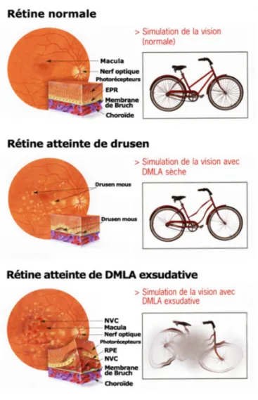 Figure 21. Illustration des désordres rétiniens associés aux deux formes de DMLA et de leurs effets sur la  vision 120 