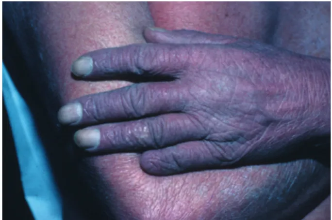 Fig. 3 : Actinodermatose du dos de la main contrastant avec l’aspect du bras peu photoexposé