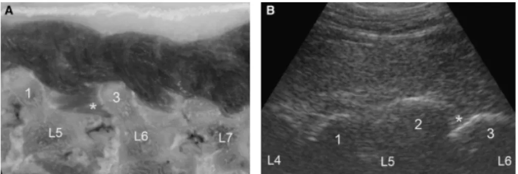 Fig. 4. Parasagittal anatomic section (A) and ultrasonographic image (B) of the caudal vertebral column of a crossed Bichon