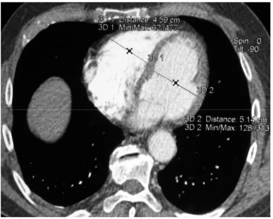 Figure 1.1.  Mesure des dimensions ventriculaires sur coupe axiale chez un  patient atteint d’embolie pulmonaire aiguë