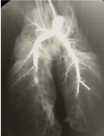 Figure 2.3. Exemple d’angiographies pulmonaires conduites post-mortem chez l’un des animaux  soumis à une embolie pulmonaire expérimentale (cliché de droite) et chez un animal sain (cliché  de gauche)