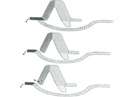 Figure 1-3  Principe  des  différentes  variantes  d’anastomose  iléo  rectales.  En  haut: 