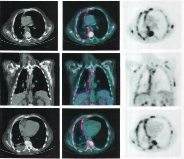 Figure 1.     Transversal and frontal metabolic imaging slices of a patient with desmoplastic mesothelioma of  the right pleural cavity at the metastatic stage.