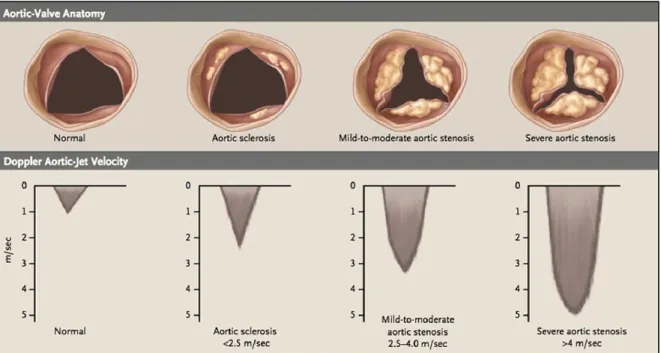 Figure 1-6: Disease progression in calcific aortic stenosis, showing changes in leaflet opening in  systole and Doppler velocities 14