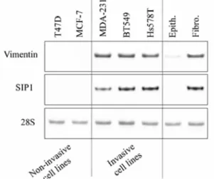 Figure 1 Expression of SIP1 correlates with vimentin expression in human breast cancer cell lines