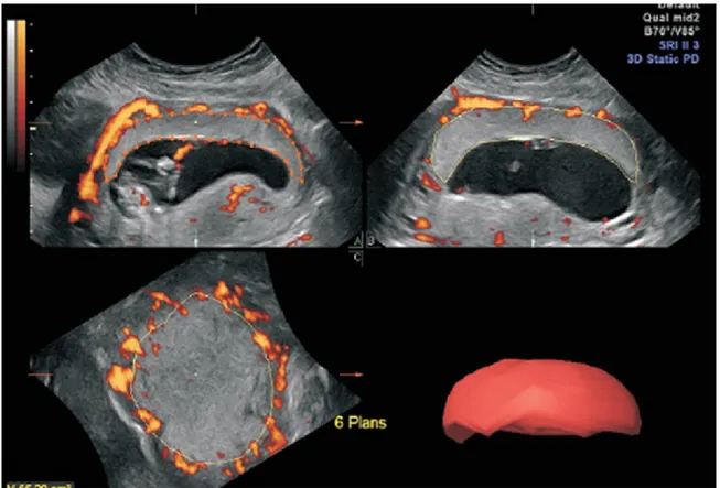 Figure 1 . Three-dimensional view of the placenta using Power Doppler 