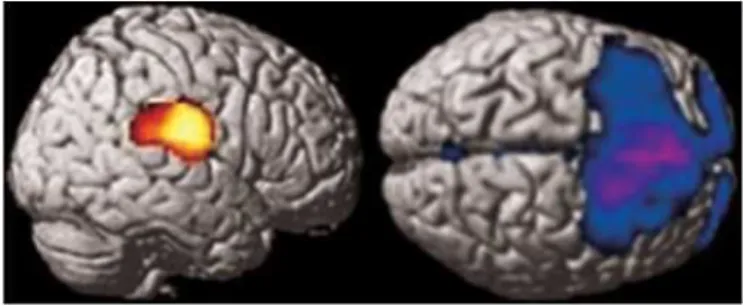 Figure 1. The comparison of Group 1 with the control group using exclusive masking by Group 2 statistical parametric  mapping analyses shows a hypermetabolic area involving the right postcentral gyrus and the right parietotemporal  junction  (left)  and  h