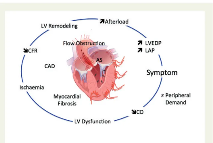 Figure 1 Schematic representation of the multifactorial factors contributing to the development of symptoms in patients with  aor-tic stenosis (AS)