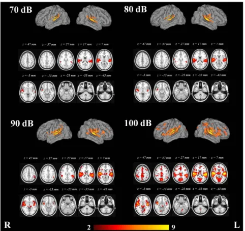 Table 2. Clusters exhibiting activation with the 70, 80, 90 and 100 dB tones in the fMRI data analysis