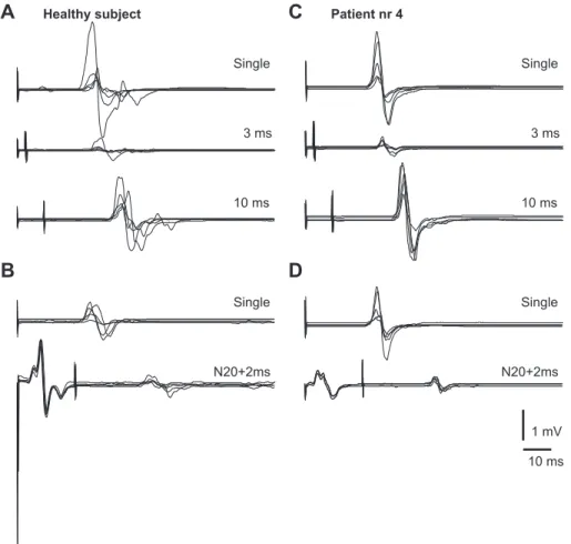 Figure 1. Examples of Motor Evoked Potentials (MEPs). An unconditioned and a conditioned Interstimuli intervals, (ISI ¼ 3 ms, ISI ¼ 10 ms, and ISI ¼ N20 þ 2 ms) MEP is shown from a healthy control (A and B) and a patient (C and D).