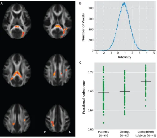 FIGURE 2. Voxel-Wise Comparisons in a Study of White Matter Integrity in Bipolar Disorder a a  Panel A depicts voxel-wise analysis showing reduced fractional anisotropy in unaffected siblings (p&lt;0.05, family-wise error corrected, within the above patien