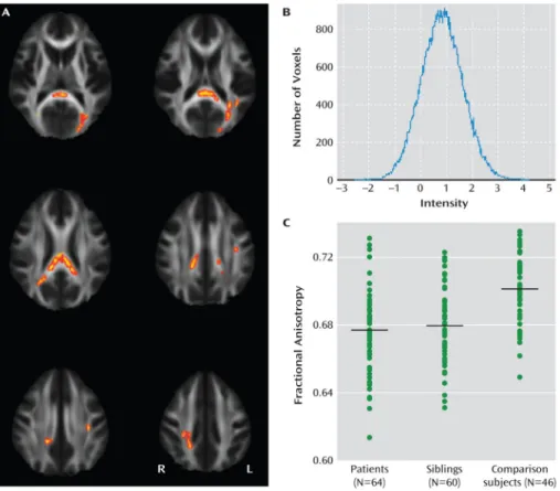 FIGURE 2. Voxel-Wise Comparisons in a Study of White Matter Integrity in Bipolar Disorder a a  Panel A depicts voxel-wise analysis showing reduced fractional anisotropy in unaffected siblings (p<0.05, family-wise error corrected, within the above patien