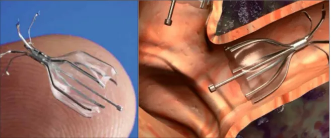 Figure 2. La valve Spiration ®  (IBV, Inc., Remond, WA ; Olympus) est une valve unidirectionnelle montée sur 6 supports en nitinol munis de crochets d’amarrage  et couverts sur la courbure d’une ombrelle en polyuréthane.