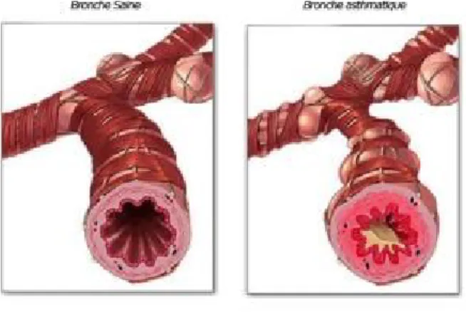 Figure 1 : Représentation d’une bronche saine (à gauche) vs une bronche asthmatique (à  droite) 9
