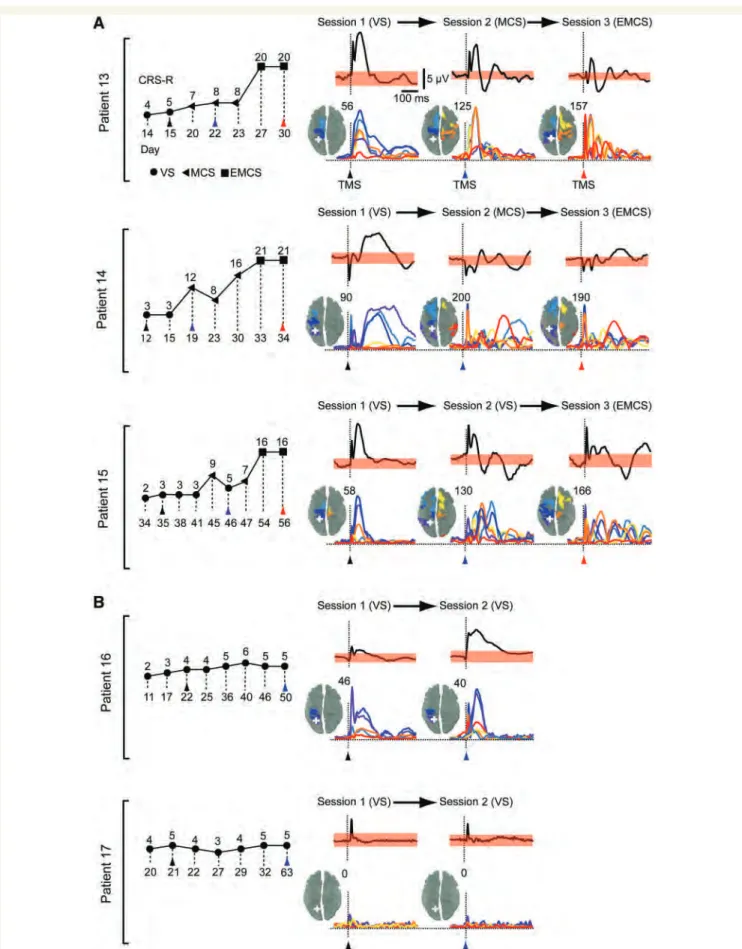 Figure 2 Clinical evaluation and TMS-evoked cortical responses in Group II patients. CRS-R total scores are plotted for the patients who were studied longitudinally (Group II) and eventually emerged from a minimally conscious state (EMCS, A) or remained in