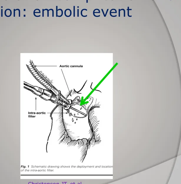 Fig. 1  Schematic drawing shows the deployment and location of the intra-aortic filter.