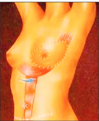 Figure 4. Lambeau DIEP