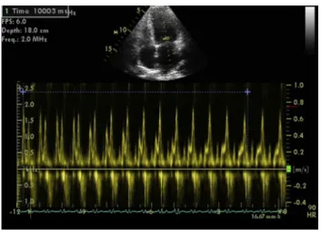 Figure 6 Continuous recording of mitral inflow during standard- standard-ized Valsalva maneuver for 10 sec showing the decrease in E/A ratio with straining, which is consistent with elevated LV filling pressures.