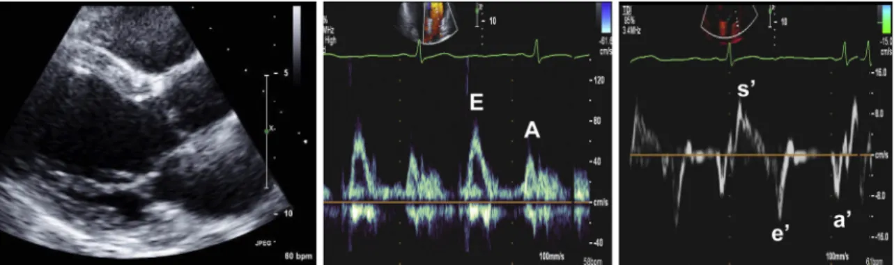 Figure 7 Example of normal findings from a young subject. Left shows normal LV size in parasternal long-axis view, with a normal mitral inflow pattern and E/A ratio &gt; 1 in middle panel