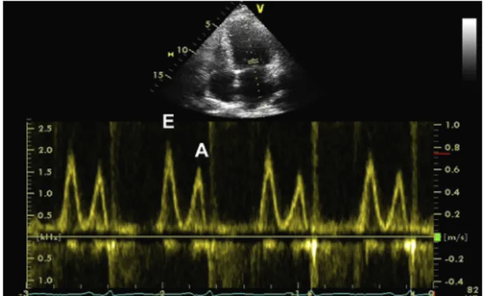 Figure 12 (Left) Mitral inflow from a patient with HFpEF. Mitral inflow pattern is consistent with elevated LV filling pressures.