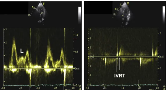 Figure 15 L velocity from a patient in sinus rhythm and increased LAP. Notice the presence of L velocity in mitral inflow and septal tissue Doppler signals (arrows).