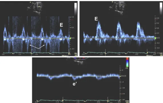 Figure 23 Mitral inflow (top left: pulsed-wave Doppler of mitral inflow at level of mitral annulus; top right: pulsed-wave Doppler of mitral inflow at level of mitral valve tips) from another heart transplantation patient in a ventricular paced rhythm and 