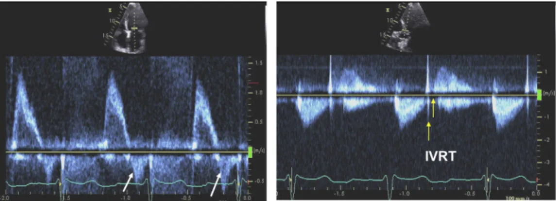 Figure 26 Doppler recordings from a patient with increased LV filling pressures. Notice the increased peak velocity and acceleration rate of the diastolic forward flow signal (left)