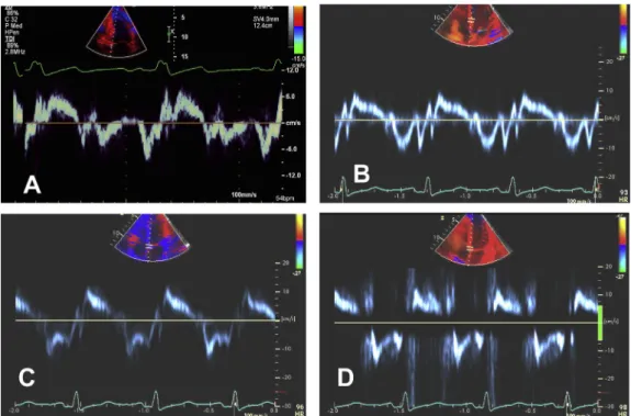 Figure 3 Tissue Doppler recordings of lateral mitral annular velocities. In (A), Doppler sample volume is located in part in LV cavity
