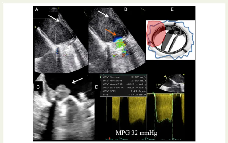 Figure 9 Mechanical valve in mitral position and thrombus obstruction. Increased transprosthetic mean pressure gradient (MPG) over a mech- mech-anical valve in mitral position (D), as assessed from the transoesophageal view and related to the presence of a