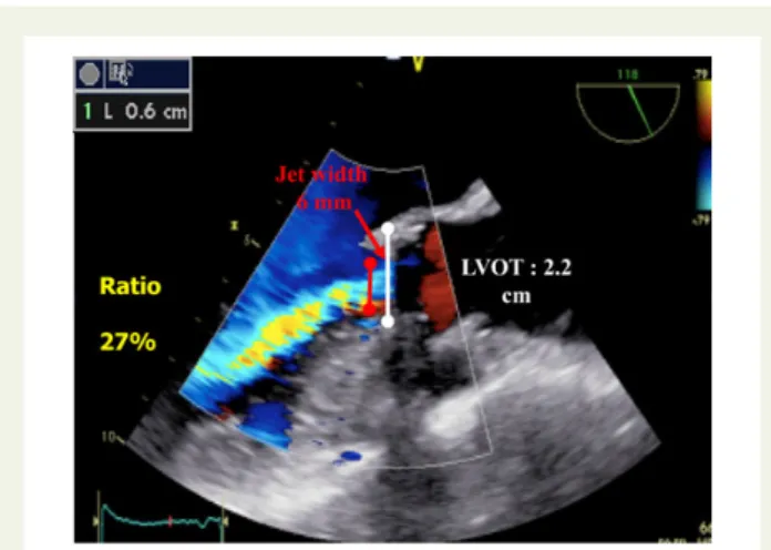 Figure 12 Severe paraprosthetic regurgitation of a mechanical prosthesis in aortic position as assessed by 3D and 2D transoesopgaheal echo- echo-cardiography (TOE)