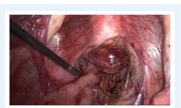 Figure 10 Dissection of the posterior compartment. Right uterosacral ligament has already been resected, the vagina is partially open with the manipulator in place.