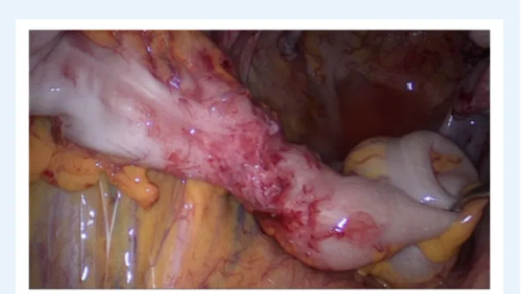 Figure 11 Symptomatic DE of the sigmoid colon with stenosis. Segmental resection is necessary.