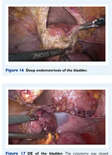 Figure 17 DE of the bladder. The cystotomy was closed transversally with 3–0 resorbable running suture