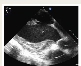 Figure 15 Transgastric long-axis view of the left ventricle