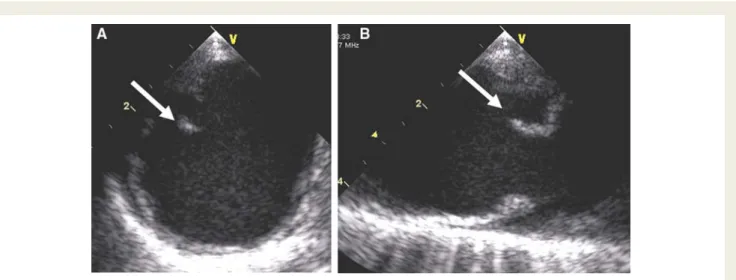 Figure 19 Pathologic specimen of the closed mitral valve, seen from the atrial side (‘surgeon’s view’)