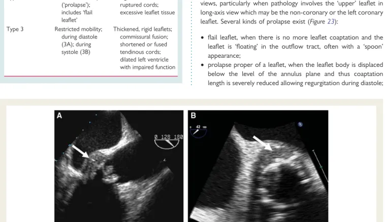 Figure 21 Infective endocarditis of bioprosthesis in aortic position, with paraprosthetic abscess characterized by aortic wall thickening with central zone of reduced reflectivity (arrows)