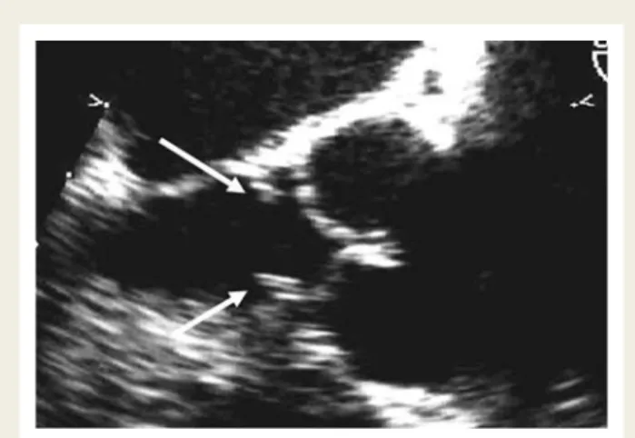 Figure 23 Prolapse and flail of the aortic valve; long-axis views. (A) Flail leaflet. (B) Whole cusp prolapse