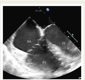Figure 1 Low transoesophageal view of right ventricle (RV), right atrium (RA), and tricuspid valve