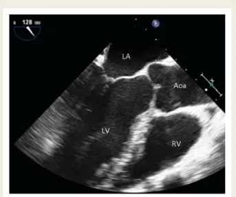 Figure 4 Transoesophageal long-axis view of the left ventricle.