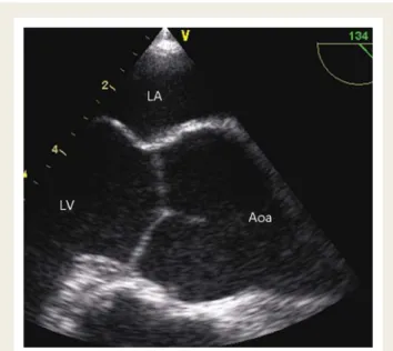 Figure 7 Long-axis view of the ascending aorta. (A) Proximal ascending aorta. (B) In the same patient, after retraction of the probe and adjust- adjust-ment of the plane orientation, a long portion of the dilated ascending aorta is seen