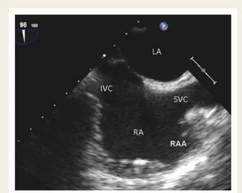 Figure 8 Left and right atrium and atrial septum in longitudinal (sagittal) view. Note orifice of superior (SVC) and inferior vena cava (IVC) and right atrial appendage (RAA).