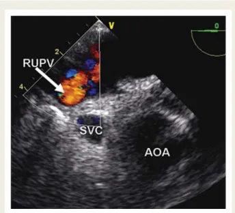 Figure 12 Transverse view of upper left atrium. Colour Doppler display of inflow from right upper pulmonary vein (RUPV, arrow)